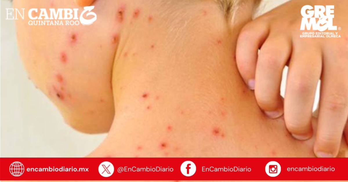 Sarampión alcanza niveles récord en Europa, advierten OMS y UNICEF