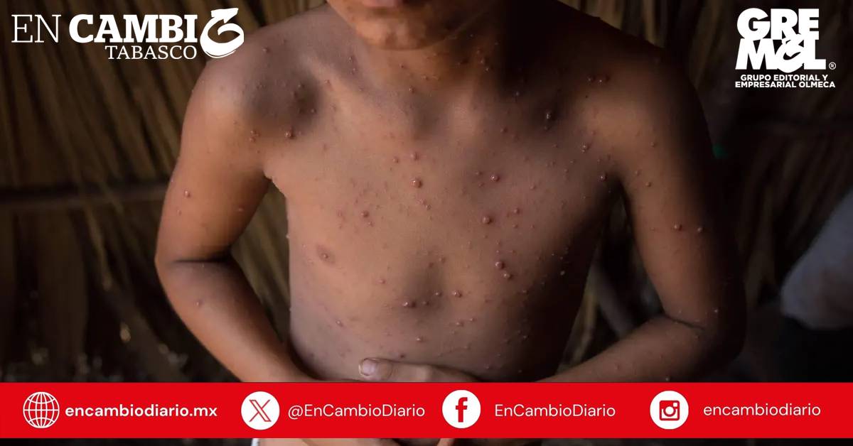 Confirman primera muerte por varicela en Tabasco; la víctima fue un menor de tres años