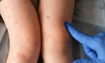 sarampión Tabasco: 92 Casos Confirmados al 31 Marzo