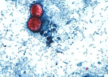 Autoridades sanitarias confirman el primer caso de Cyclospora en Aguascalientes.