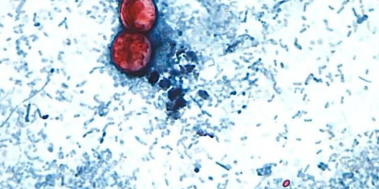 Autoridades sanitarias confirman el primer caso de Cyclospora en Aguascalientes.